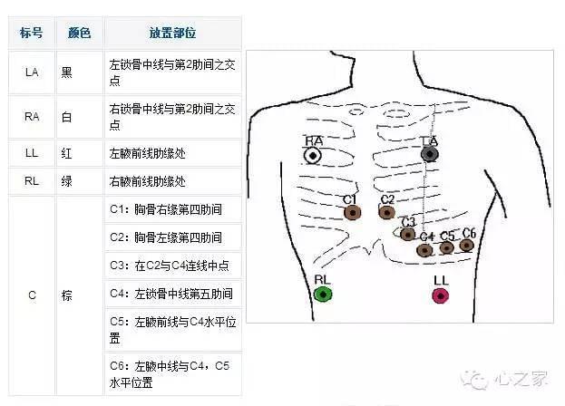 感兴趣的朋友可以参考下面zui常见的心电5导联连接正确位置示意图